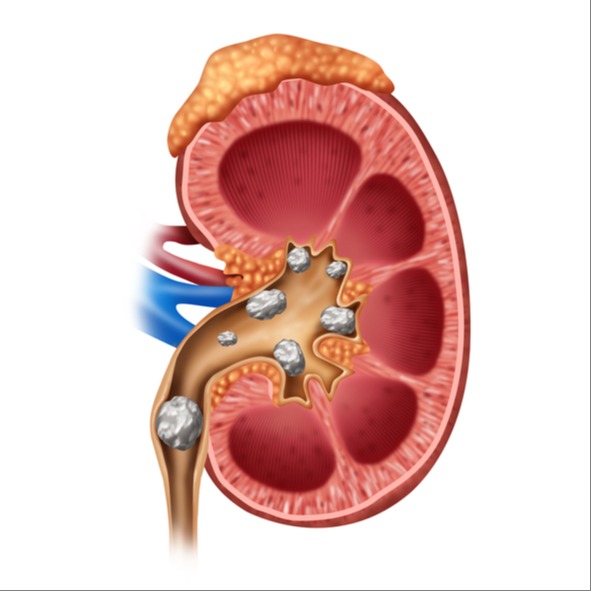 Scopri di più sull'articolo Calcoli renali e arenella, quale acqua scegliere ?